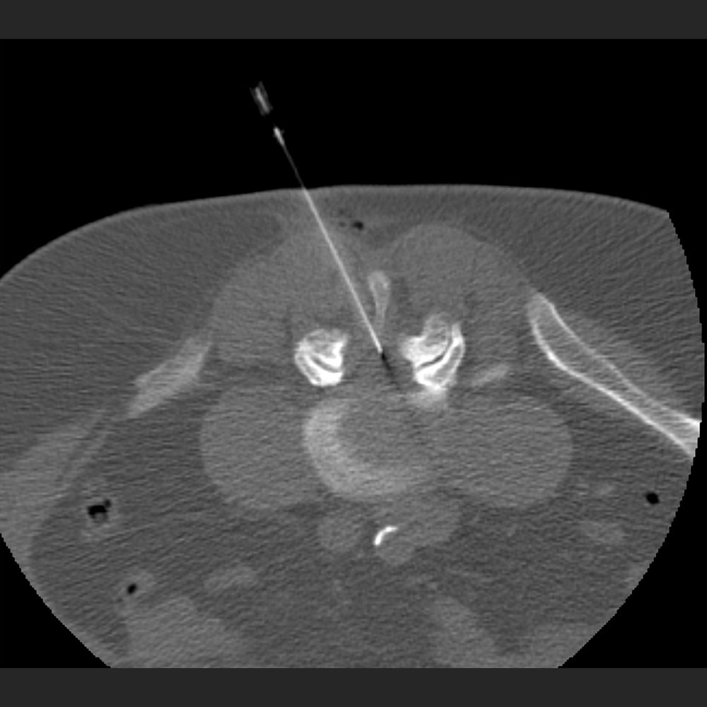 CT gesteuerte epidurale Infiltration der Lendenwirbelsäule