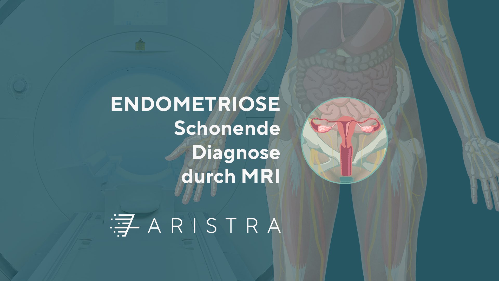 MRI zur Diagnose von Endometriose Titelbild