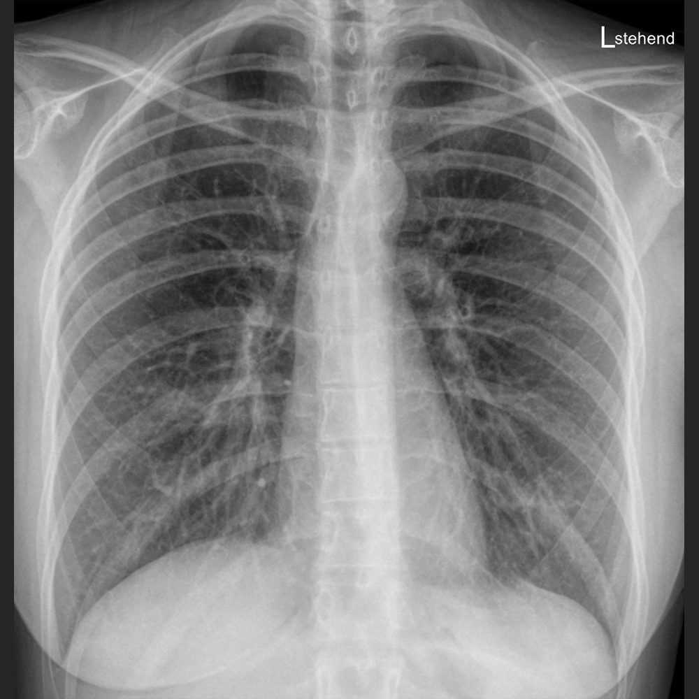 Thorax CT normal